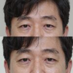 문재인 전 대통령의 상안검 수술 전후 비교 모습. 눈 위꺼풀 처짐이 개선되고 눈매가 또렷해진 사진